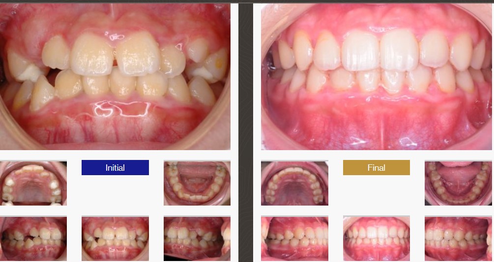 Invisalign