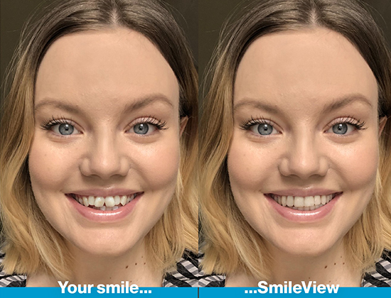 Invisalign